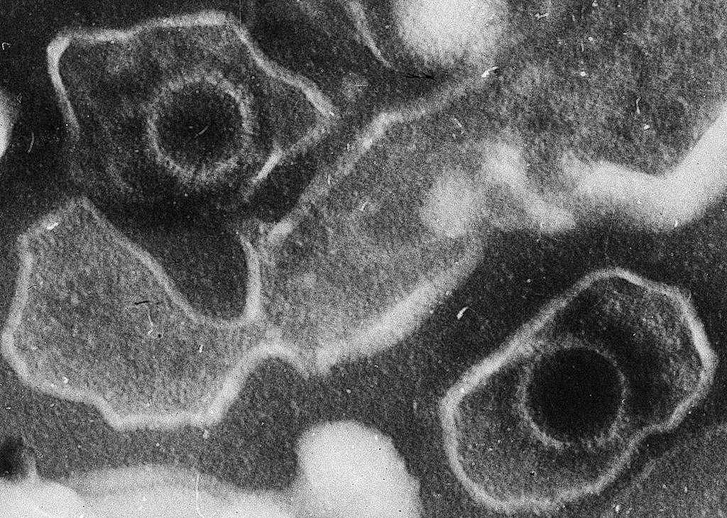 Medikament soll Epstein-Barr-Virus als Auslöser von Krebs verhindern