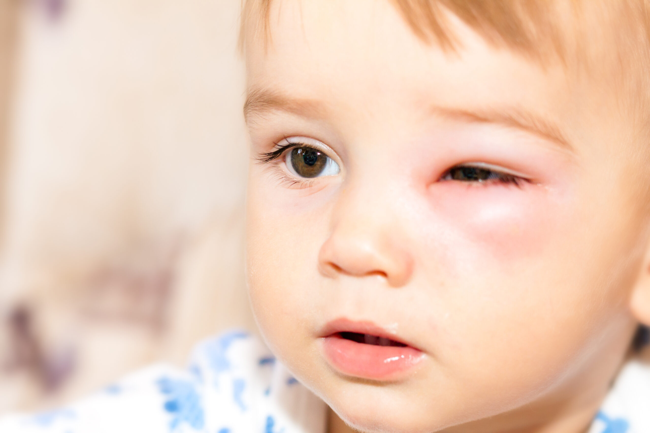 Allergie-Sprechstunde für den Notfall