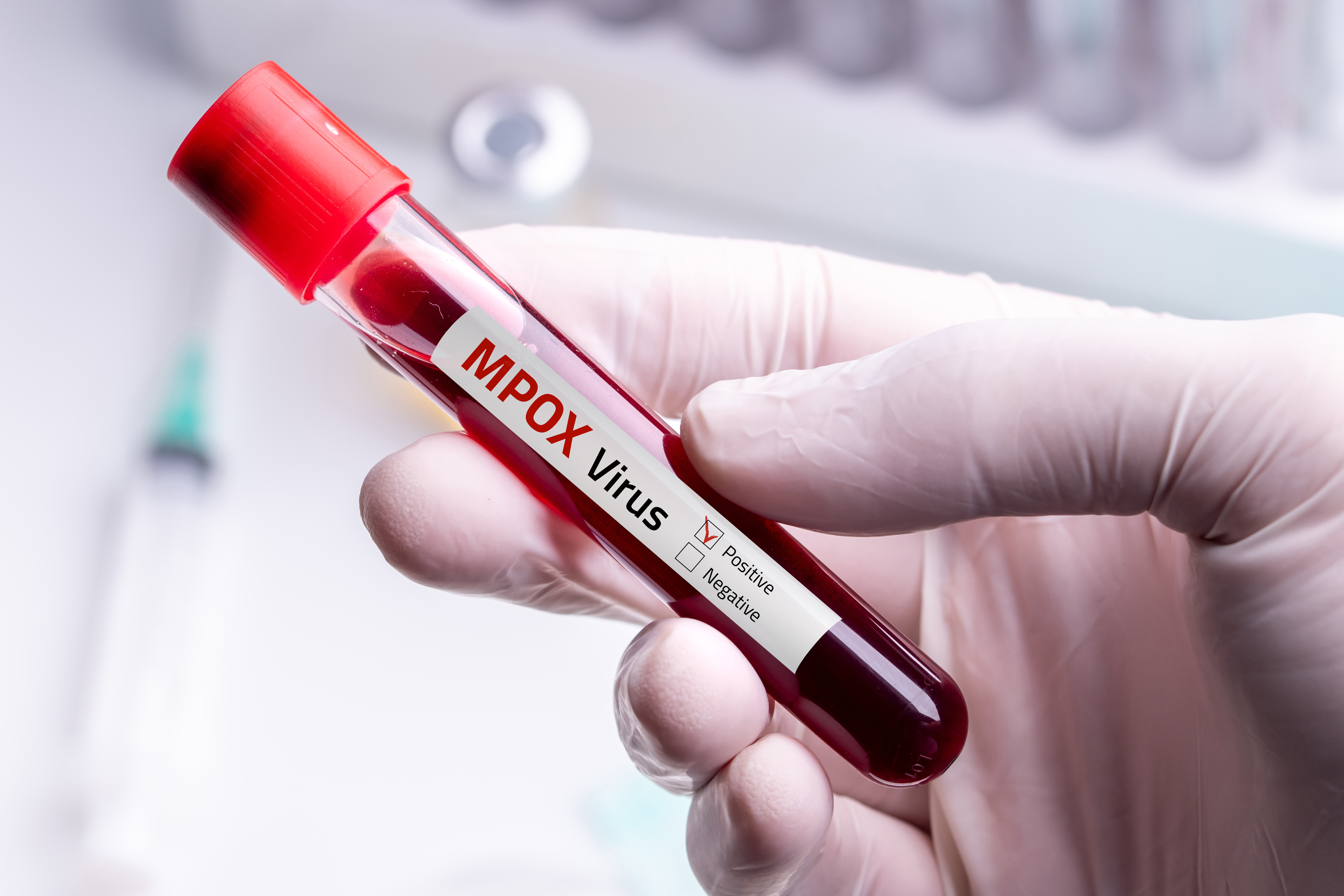 Erster Mpox-Fall mit neuer Virusvariante in Deutschland