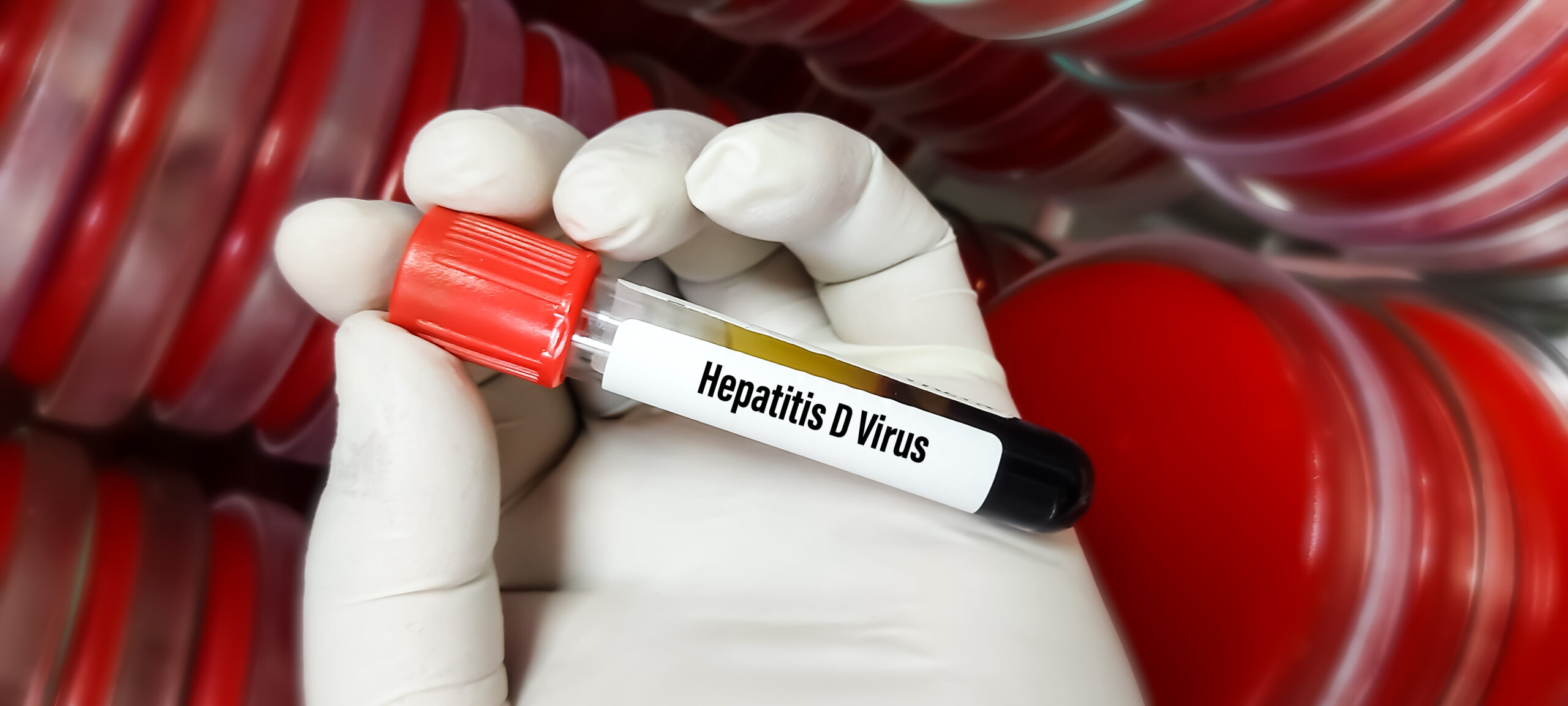 MedUni Wien warnt vor unerkannter Hepatitis D