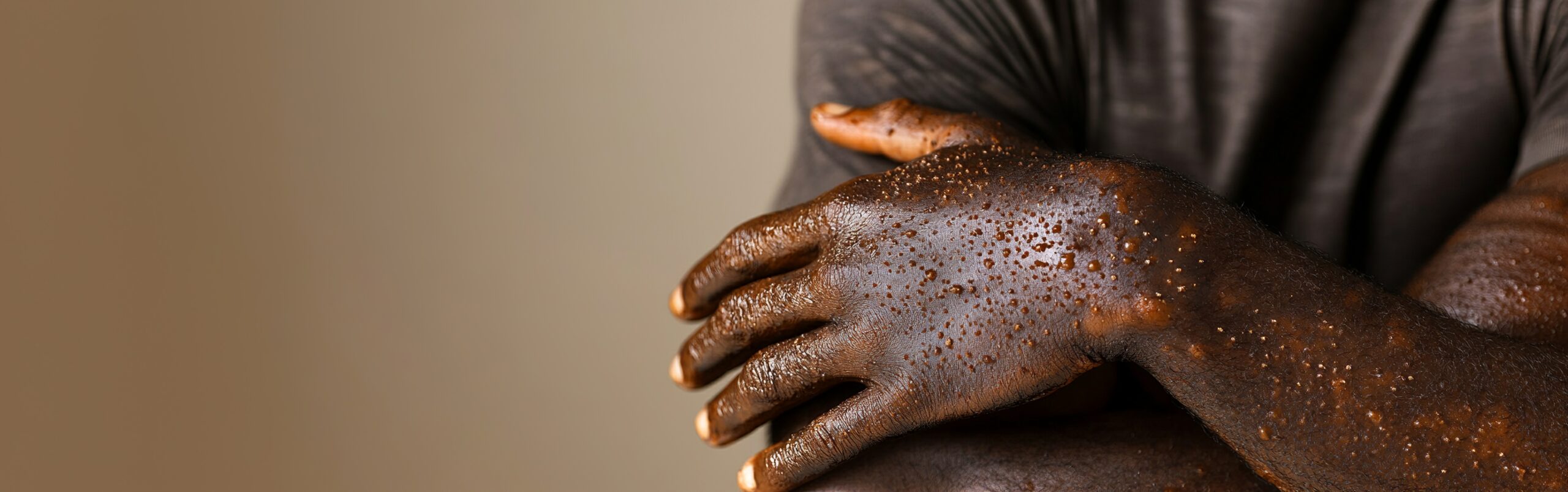 Mpox: Warnung vor weltweiter Epidemie