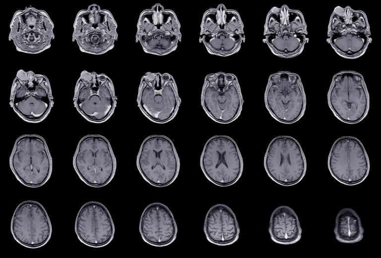 MRT Bilder eines Kopfes
