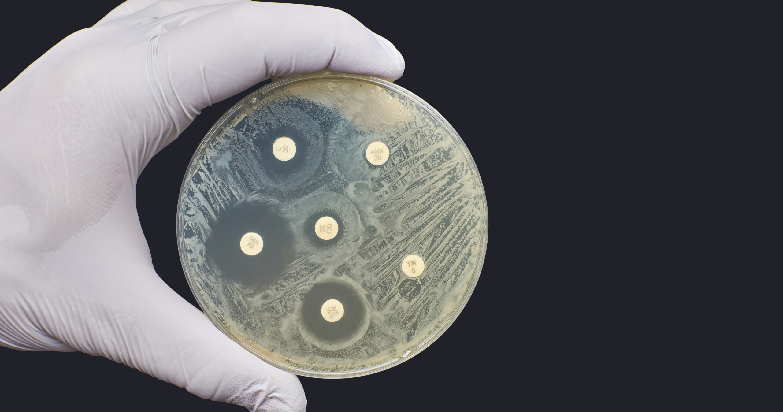 Symbolbild: Antibiogramm. Auf einer Petrischalge sind Bakterien aufgebracht. Resistente Keime bilden keinen Hof um das aufgebracht Antibiotikum. Sensible Keine sterben ab und bilden einen sichtbaren Hof. Eine Hand mit Gummihandschuh hält das Antibiogramm.