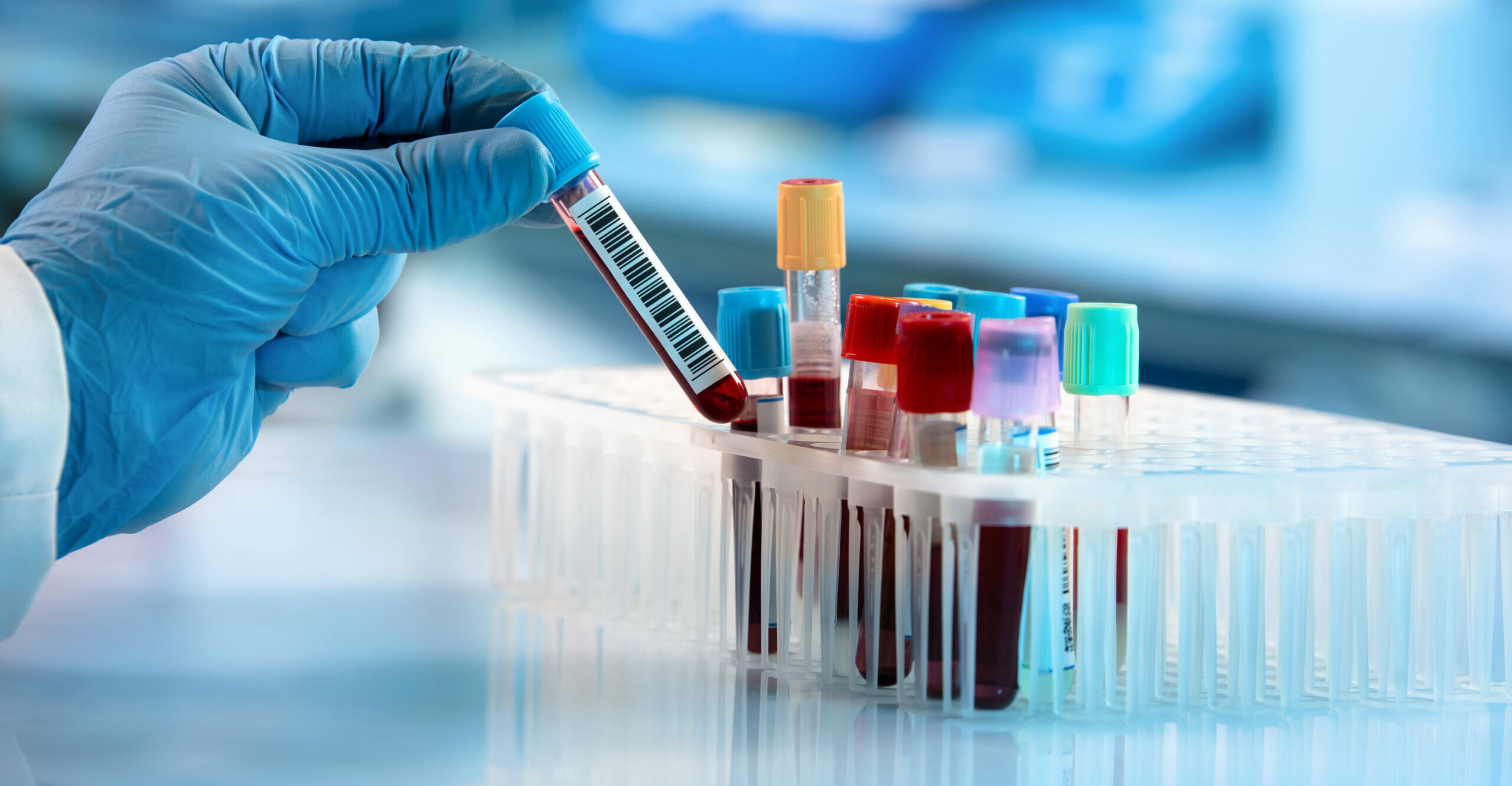 Symbolbild: ine Hand mit Gummihandschuh hält eine Blut-Eprouvette.