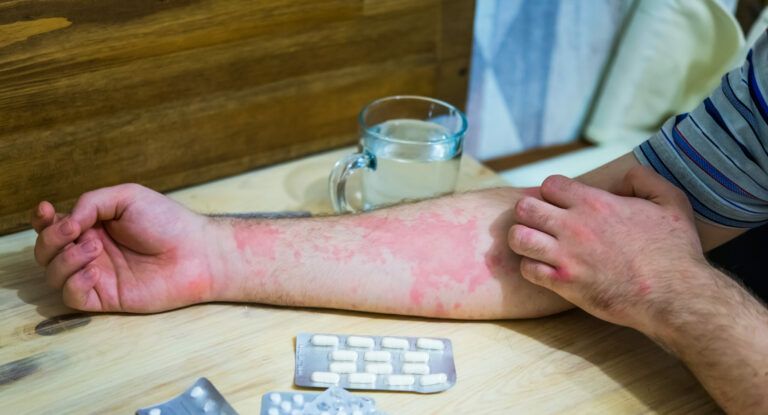 Symbolbild: Eine Hand mit starkem Ekzem liegt neben Medikamentenblistern.