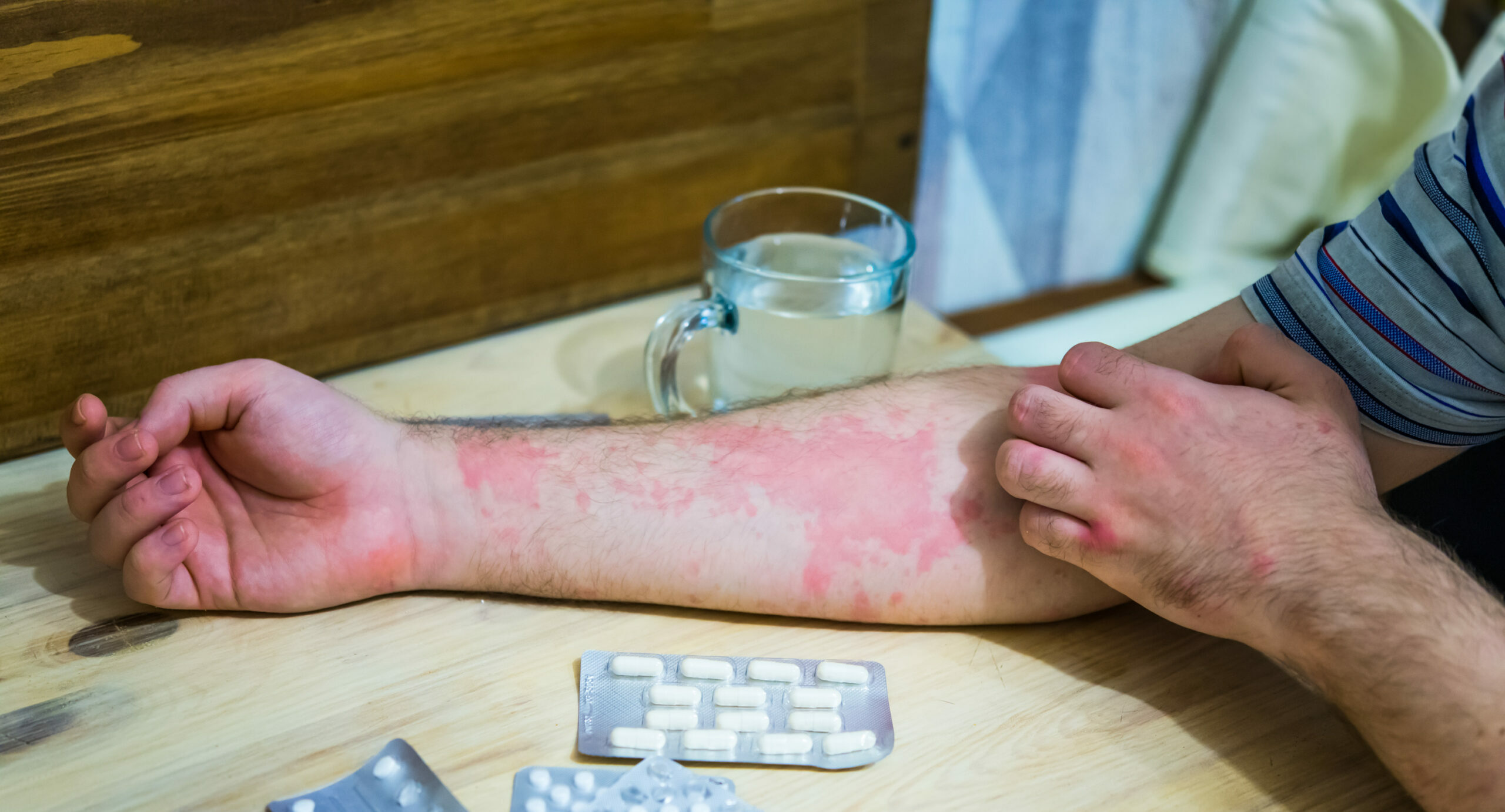 Symbolbild: Eine Hand mit starkem Ekzem liegt neben Medikamentenblistern.