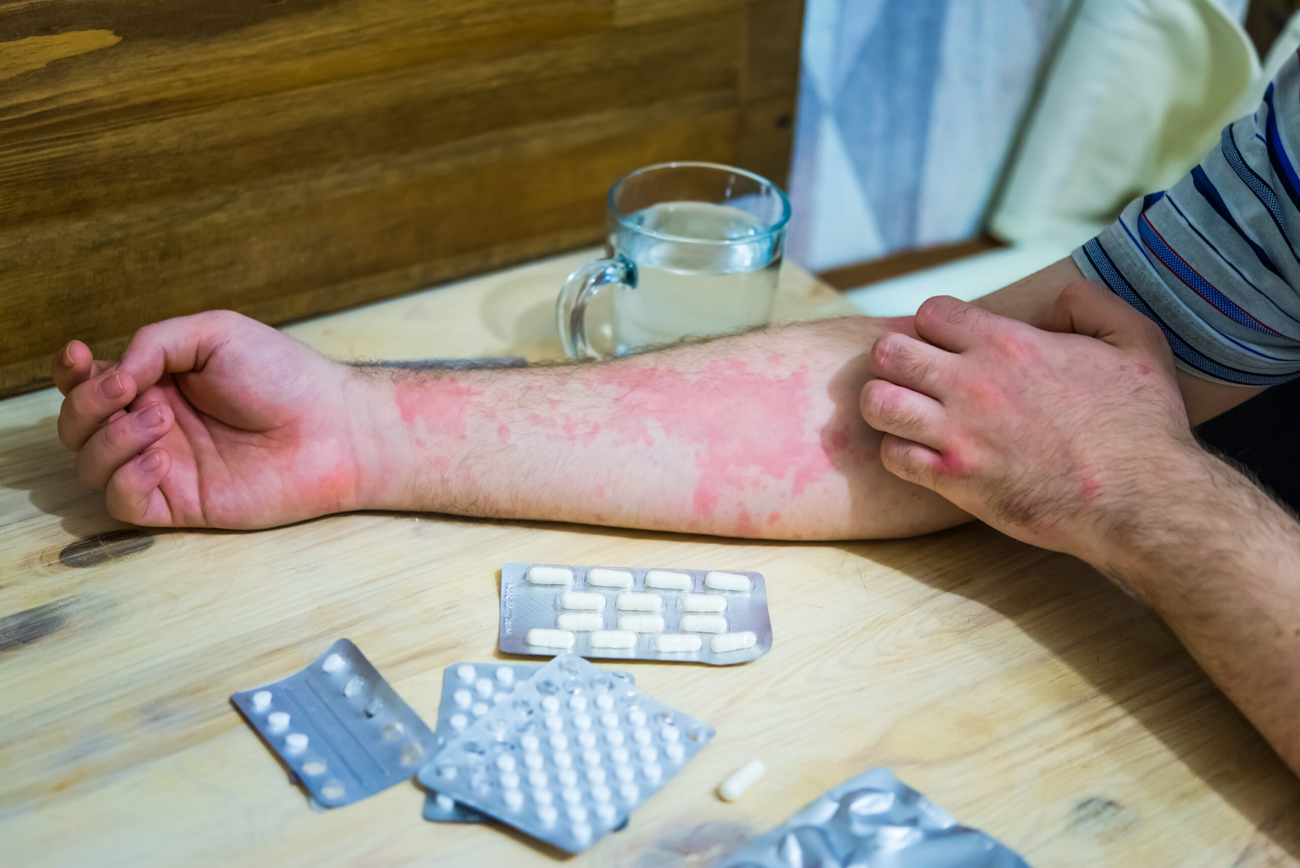 Symbolbild: Eine Hand mit starkem Ekzem liegt neben Medikamentenblistern.