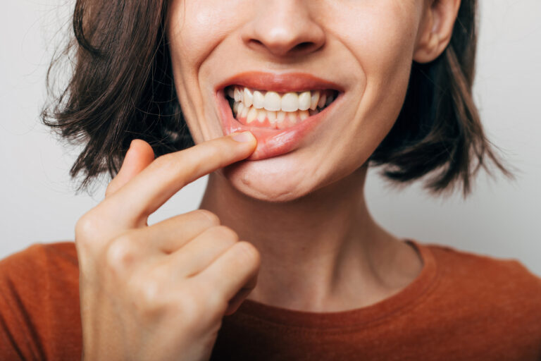 Symbolbild: Eine junge Frau zieht ihre Lippe herunter. Ihr Zahnfleisch ist entzündet.