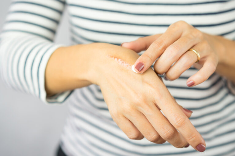 Symbolbild: Eine Frau versorgt ihre Narbe auf der Hand.