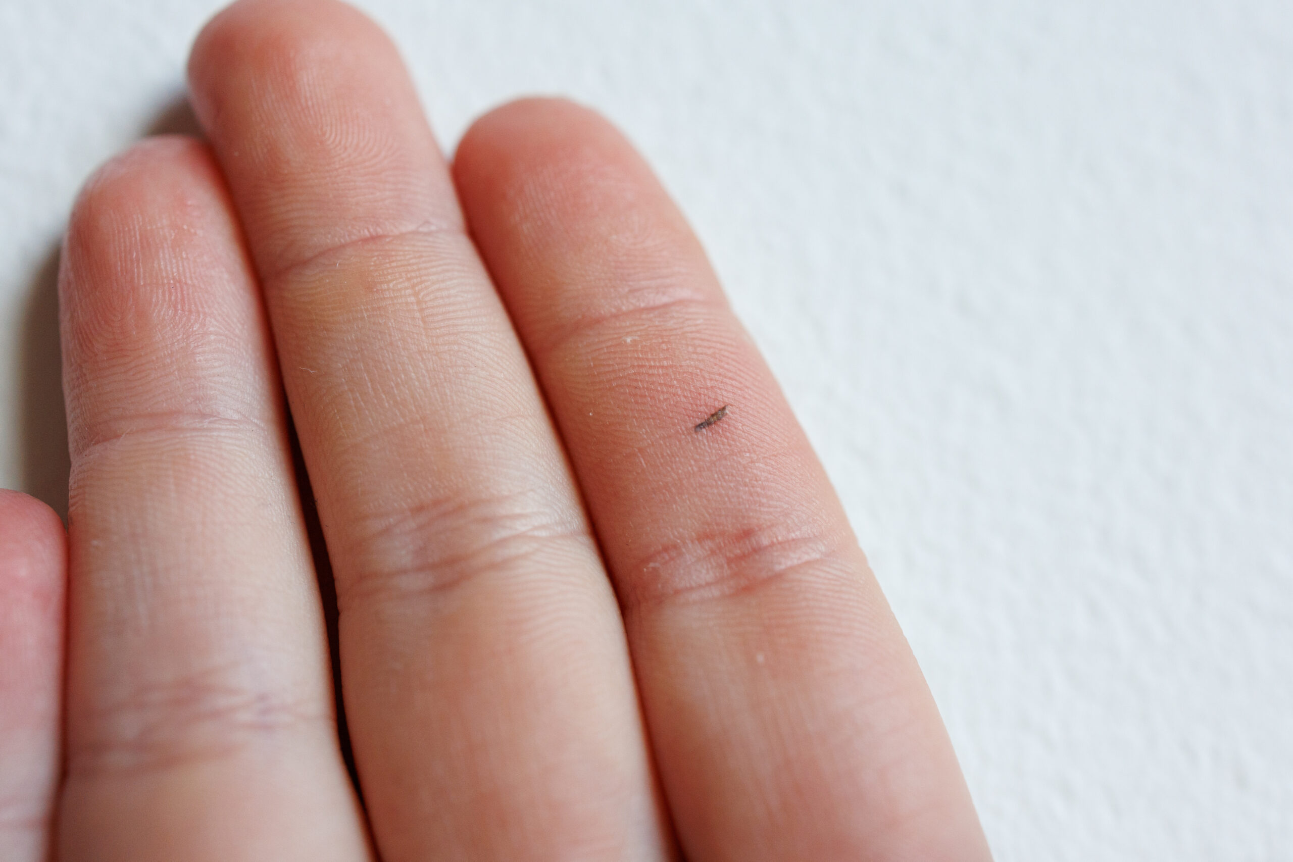 Symbolbild: Nahaufnahme von einer Hand mit einem Splitter im Zeigefinger.