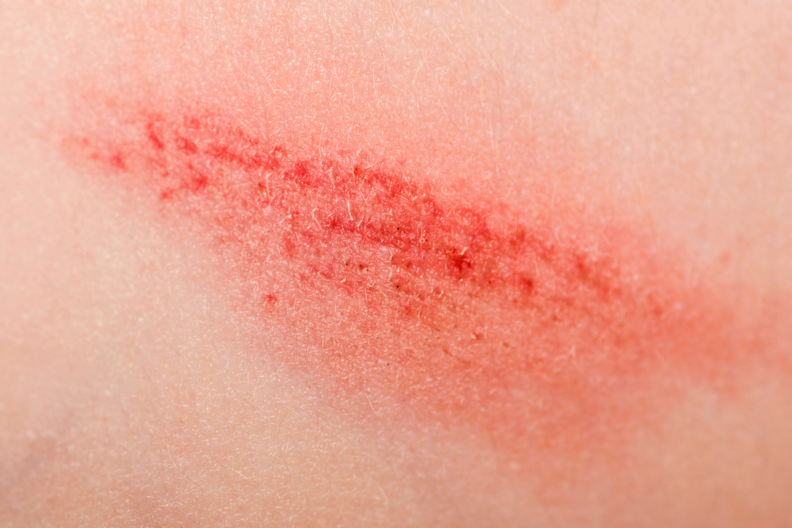 Borkenflechte im Sommer: Ursachen, Symptome und Ansteckung