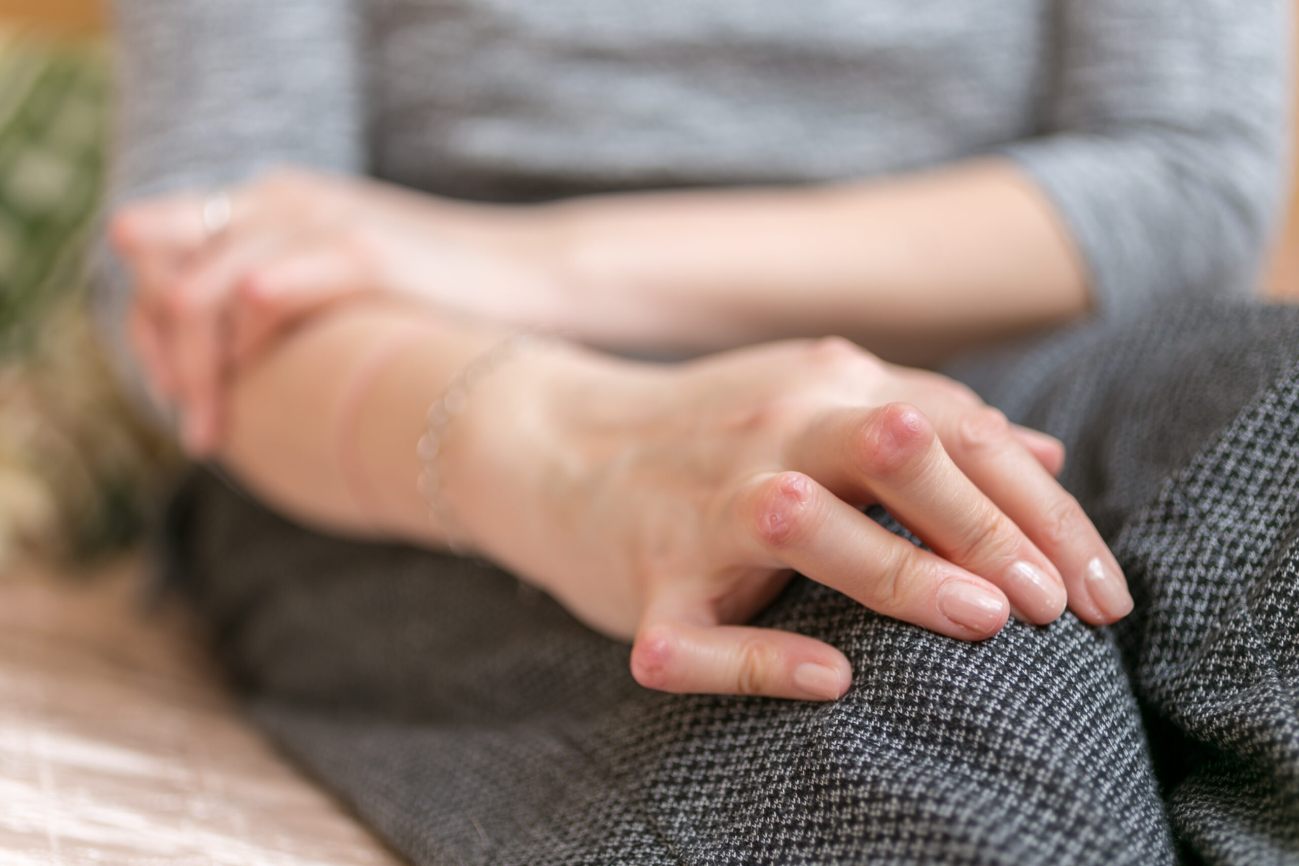 Symbolbild: Eine Hand mit geschwollenen Fingergelenken, wie sie bei rheumatoider Arthritis auftreten können.