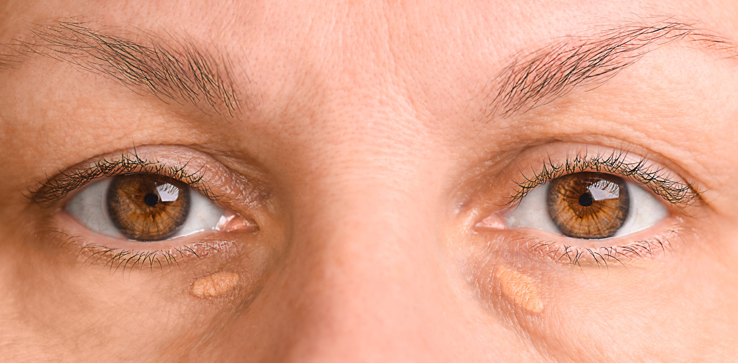Symbolbild: Eine Frau hat Xanthelasmen, diese gelben Ablagerungen unter den Augen.