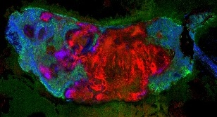 Darmkrebs: Ceramide fördern Metastasenbildung