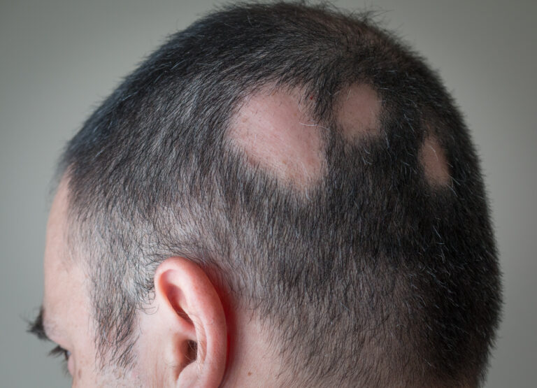 Symbolbild: Ein Mann hat Kreisrunden Haarausfall. Er hat kahle Lücken im Haar.